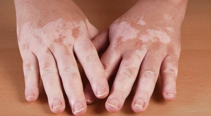 Cbd: En naturlig hjælp i kampen mod vitiligo – vælg kvalitet fra formula swiss